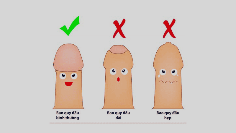 Hình ảnh bao quy đầu dài, hẹp Hình ảnh bao quy đầu dài, hẹp
