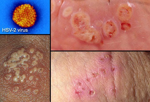 herpes sinh dục là bệnh lây truyền qua đường tình dục phổ biến và vô cùng nguy hiểm herpes sinh dục là bệnh lây truyền qua đường tình dục phổ biến và vô cùng nguy hiểm