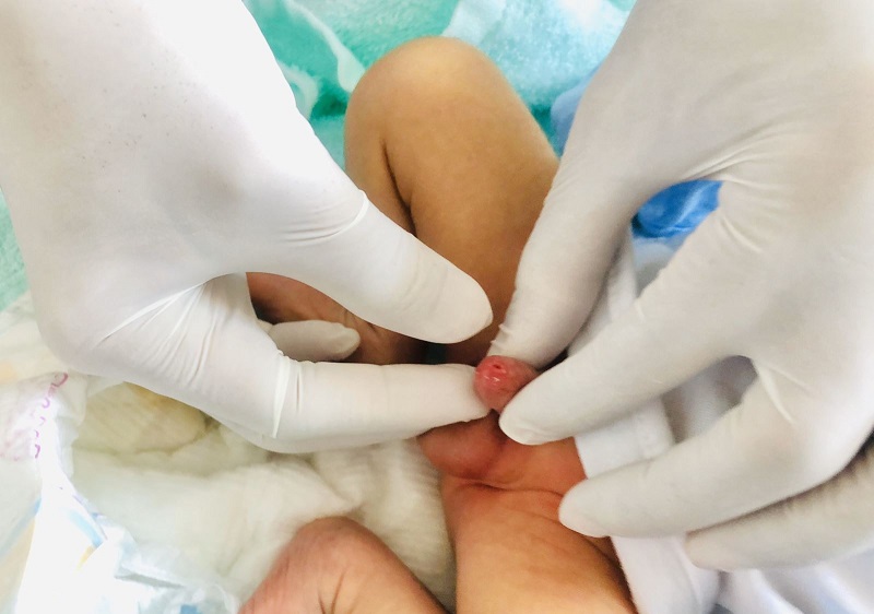 dấu hiệu hẹp bao quy đầu ở trẻ nhỏ dấu hiệu hẹp bao quy đầu ở trẻ nhỏ