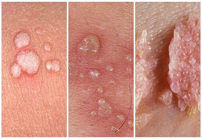 hình ảnh sùi mào gà giai đoạn đầu ở nam hình ảnh sùi mào gà giai đoạn đầu ở nam