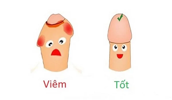 dấu hiệu viêm quy đầu ở nam giới dấu hiệu viêm quy đầu ở nam giới
