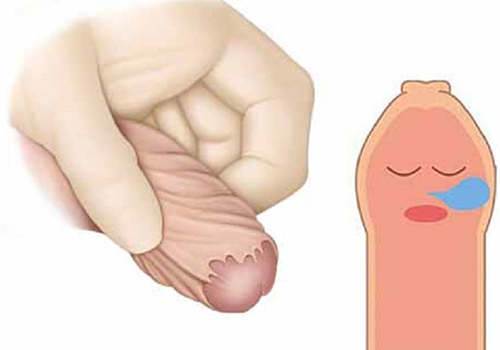 nong bao quy đầu giúp điều trị tình trạng bao quy đầu bị hẹp nong bao quy đầu giúp điều trị tình trạng bao quy đầu bị hẹp