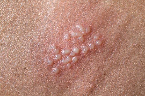 bệnh lậu ở nam giới giai đoạn đầu 