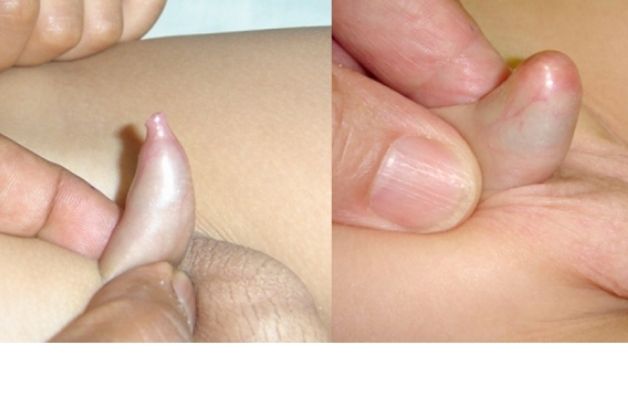 hình ảnh hẹp bao quy đầu ở trẻ Hình ảnh hẹp bao quy đầu ở trẻ