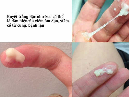 dấu hiệu khí hư bất thường ở nữ giới dấu hiệu khí hư bất thường ở nữ giới