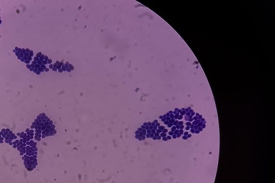 nấm Candida là nguyên nhân gây viêm nấm âm đạo nấm Candida là nguyên nhân gây viêm nấm âm đạo