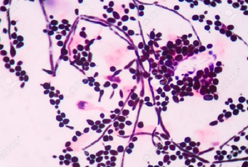 nấm candida ở vùng kín   nấm candida ở vùng kín