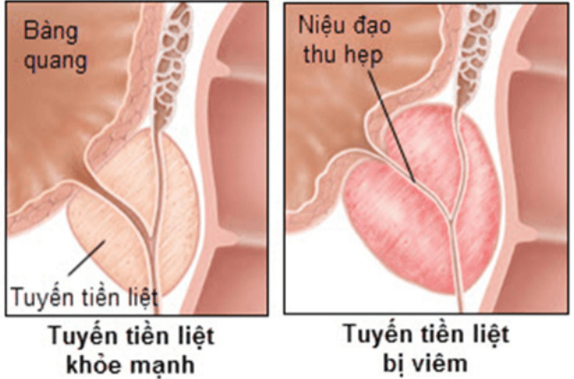 hình ảnh viêm tuyến tiền liệt (phải) hình ảnh viêm tuyến tiền liệt (phải)