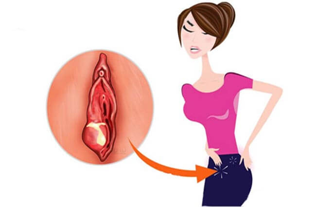 âm đạo sưng đau tiết dịch bất thường âm đạo sưng đau tiết dịch bất thường