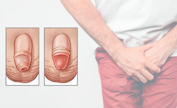 hình ảnh dài bao quy đầu ở nam giới hình ảnh dài bao quy đầu ở nam giới