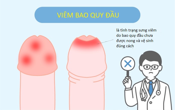 dấu hiệu viêm quy đầu ở nam giới dấu hiệu viêm quy đầu ở nam giới