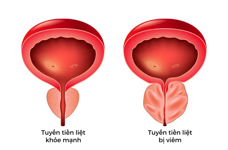 nam giới đau tuyến tiền liệt có thể do bị viêm nam giới đau tuyến tiền liệt có thể do bị viêm