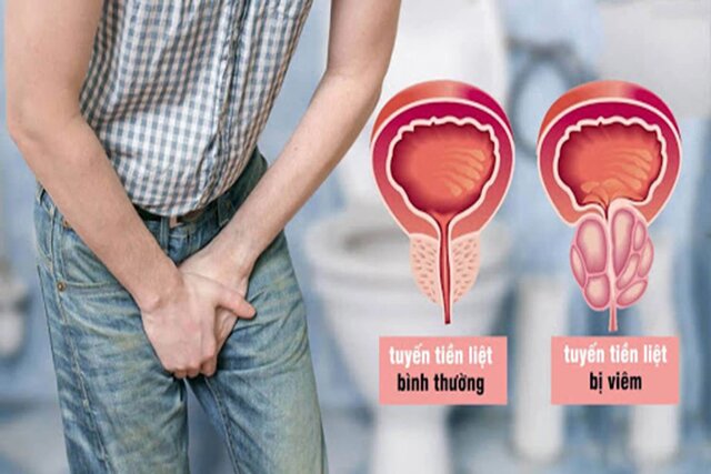 viêm tuyến tiền liệt có thể gây tiểu buốt có mủ viêm tuyến tiền liệt có thể gây tiểu buốt có mủ