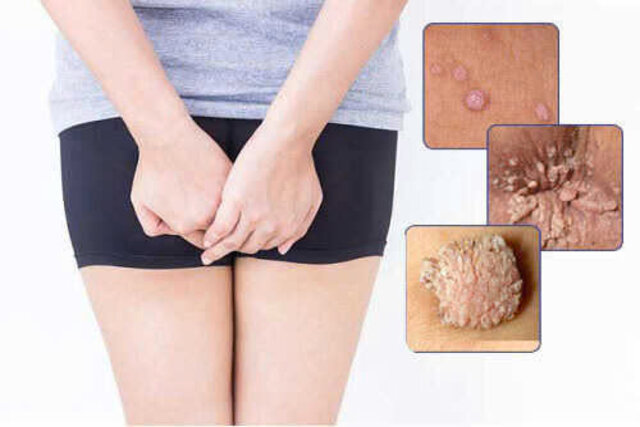trên bộ phận sinh dục hoặc hậu môn của người bệnh sùi mào gà xuất hiện nốt sần thô ráp, màu da hoặc xám trắng trên bộ phận sinh dục hoặc hậu môn của người bệnh sùi mào gà xuất hiện nốt sần thô ráp, màu da hoặc xám trắng