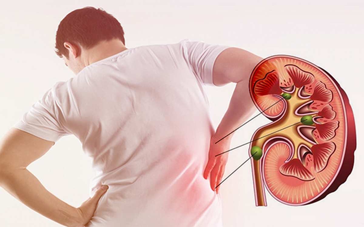 đi tiểu nhiều lần có thể là dấu hiệu của bệnh sỏi thận đi tiểu nhiều lần có thể là dấu hiệu của bệnh sỏi thận