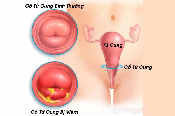 viêm cổ tử cung có thể do viêm âm đạo tiến triển viêm cổ tử cung có thể do viêm âm đạo tiến triển