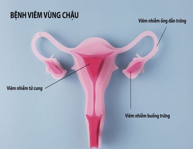 khí hư bất thường là một trong những dấu hiệu của bệnh vùng chậu khí hư bất thường là một trong những dấu hiệu của bệnh vùng chậu