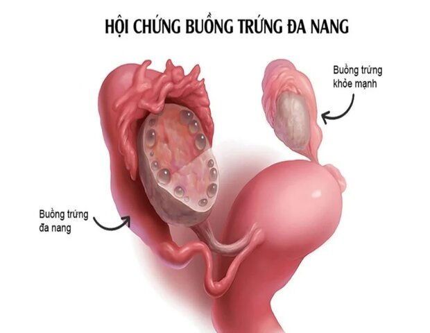 hội chứng buồng trứng đa nang (PCOS) có thể gây tắc kinh 3 tháng hội chứng buồng trứng đa nang (PCOS) có thể gây tắc kinh 3 tháng