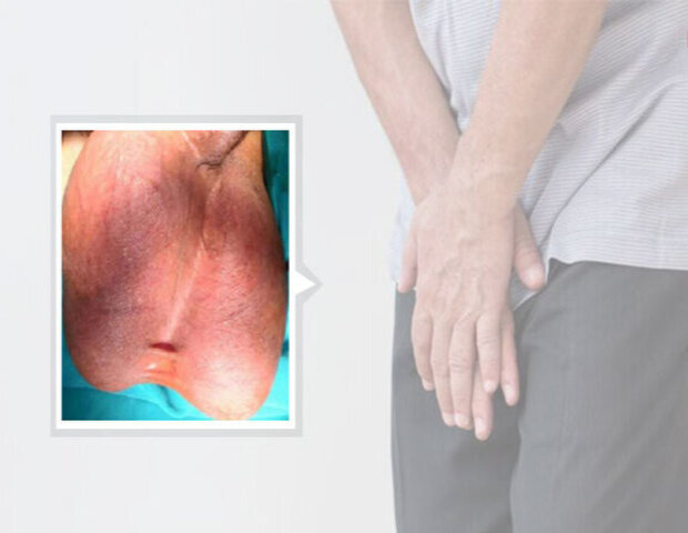 nam giới có thể bị đau đớn do sưng bìu tinh hoàn nam giới có thể bị đau đớn do sưng bìu tinh hoàn