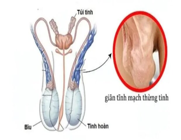 giãn tĩnh mạch thừng tinh là bệnh lý rất hay gặp hiện nay giãn tĩnh mạch thừng tinh là bệnh lý rất hay gặp hiện nay