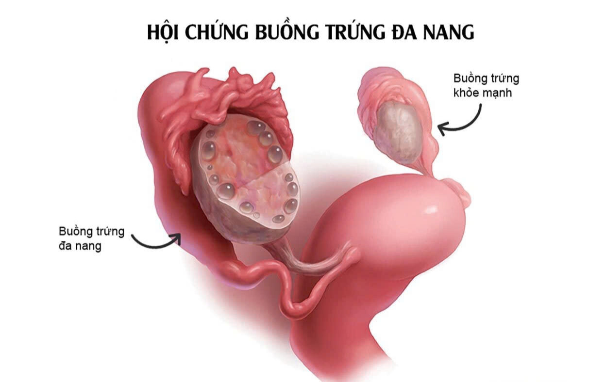 polyp tử cung có thể là nguyên nhân gây ra hội chứng buồng trứng đa nang polyp tử cung có thể là nguyên nhân gây ra hội chứng buồng trứng đa nang