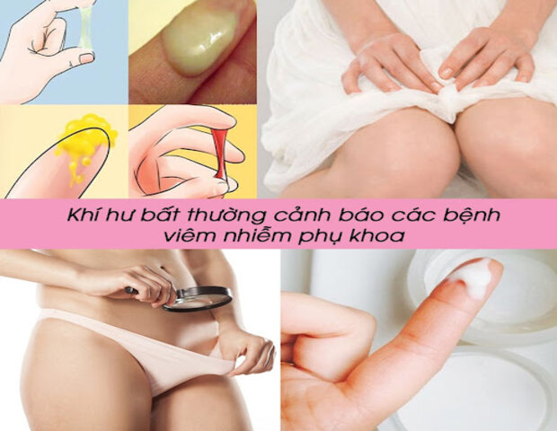 khí hư bất thường có thể là dấu hiệu viêm lộ tuyến cổ tử cung khí hư bất thường có thể là dấu hiệu viêm lộ tuyến cổ tử cung
