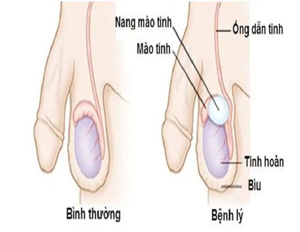 u nang mào tinh hoàn dễ nhầm lẫn với ung thư tinh hoàn u nang mào tinh hoàn dễ nhầm lẫn với ung thư tinh hoàn