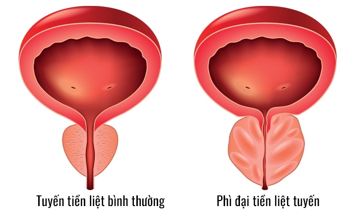 nam giới bị đau khi đi tiểu có thể do bị viêm hoặc phì đại tuyến tiền liệt nam giới bị đau khi đi tiểu có thể do bị viêm hoặc phì đại tuyến tiền liệt