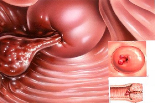 hình ảnh polyp cổ tử cung hình ảnh polyp cổ tử cung