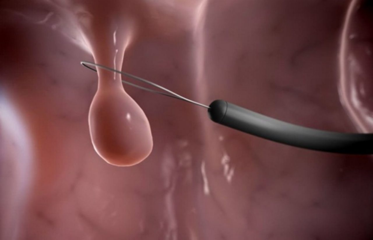 phẫu thuật là một trong những phương pháp điều trị polyp cổ tử cung hiệu quả phẫu thuật là một trong những phương pháp điều trị polyp cổ tử cung hiệu quả