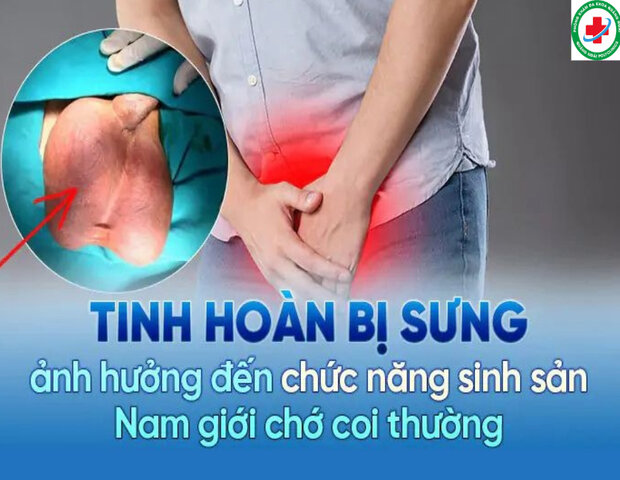 hiện tượng khi một bên bìu phải (túi da chứa tinh hoàn) bị phình to hiện tượng khi một bên bìu phải (túi da chứa tinh hoàn) bị phình to
