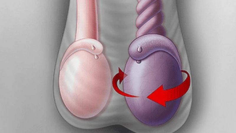 một bên tinh hoàn bị đau nhức trong khi bên còn lại vẫn bình thường một bên tinh hoàn bị đau nhức trong khi bên còn lại vẫn bình thường