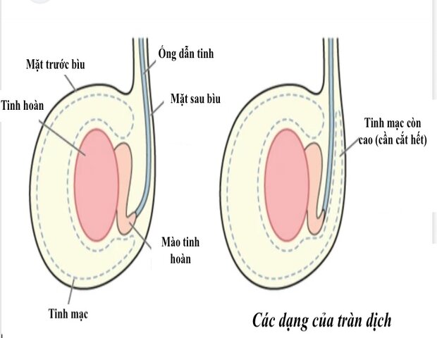 nguyên nhân chính dẫn đến tình trạng sưng bìu bên trái nguyên nhân chính dẫn đến tình trạng sưng bìu bên trái