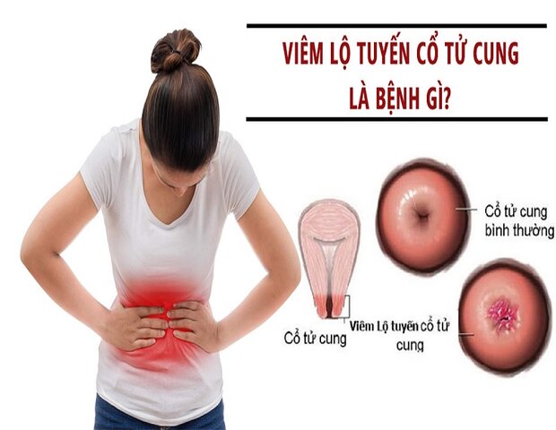khi viêm nhiễm vùng lộ tuyến cổ tử cung có thể bị sưng đỏ, chảy dịch khi viêm nhiễm vùng lộ tuyến cổ tử cung có thể bị sưng đỏ, chảy dịch