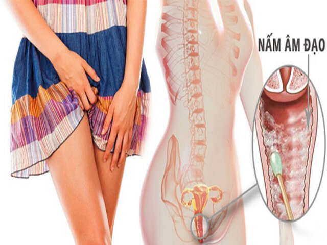viêm nấm phụ khoa do nấm Candida viêm nấm phụ khoa do nấm Candida