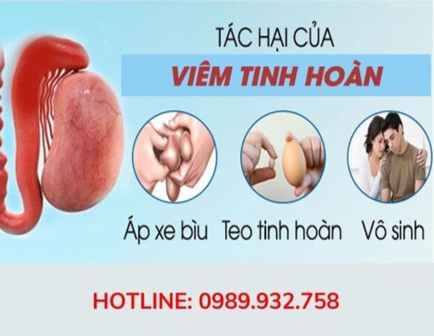 viêm tinh hoàn nên điều trị sớm để tránh biến chứng viêm tinh hoàn nên điều trị sớm để tránh biến chứng