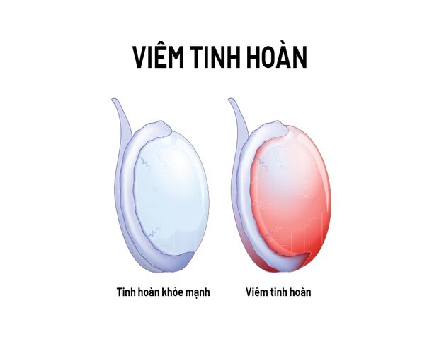 viêm tinh hoàn ở nam giới viêm tinh hoàn ở nam giới