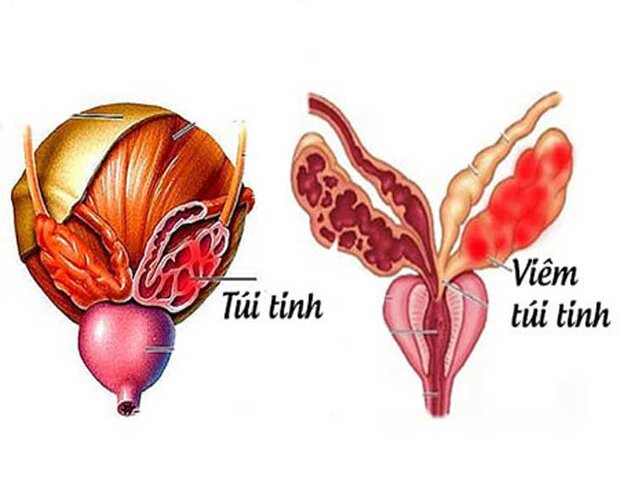 viêm túi tinh do nhiều nguyên nhân gây ra viêm túi tinh do nhiều nguyên nhân gây ra