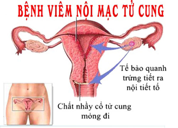 hình ảnh viêm nội mạc tử cung hình ảnh viêm nội mạc tử cung