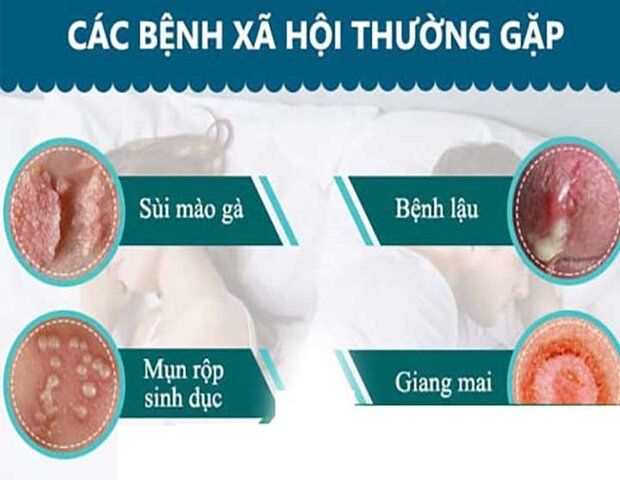 bệnh xã hội là nguyên nhân khiến “cậu nhỏ” nổi mụn trắng bệnh xã hội là nguyên nhân khiến “cậu nhỏ” nổi mụn trắng