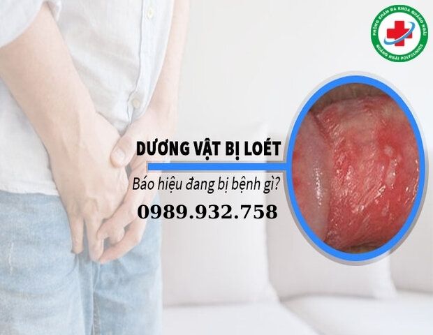 nếu xuất hiện vết loét trên thân dương vật nam giới cần đi khám ngay lập tức nếu xuất hiện vết loét trên thân dương vật nam giới cần đi khám ngay lập tức
