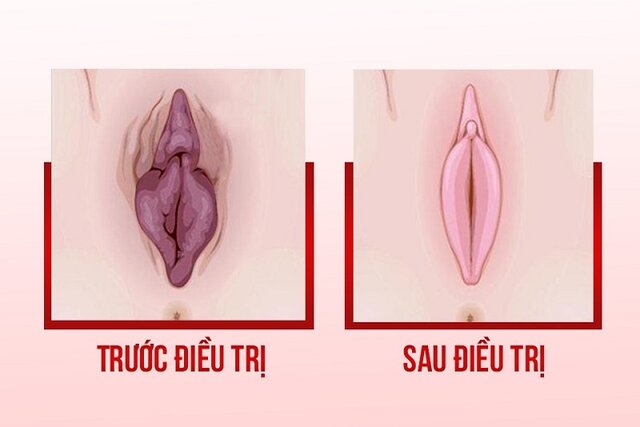 vùng kín như được tái sinh sau khi tân trang vùng kín như được tái sinh sau khi tân trang