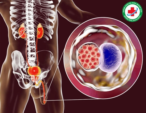 bệnh viêm niệu đạo ở nam giới bệnh viêm niệu đạo ở nam giới