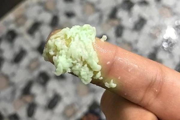 dịch tiết màu xanh bã đậu là dấu hiệu cảnh báo về bệnh viêm cổ tử cung  dịch tiết màu xanh bã đậu là dấu hiệu cảnh báo về bệnh viêm cổ tử cung