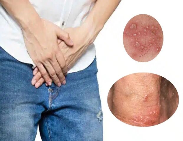 dương vật nổi mụn có mủ là dấu hiệu cảnh báo nhiều bệnh nam khoa dương vật nổi mụn có mủ là dấu hiệu cảnh báo nhiều bệnh nam khoa