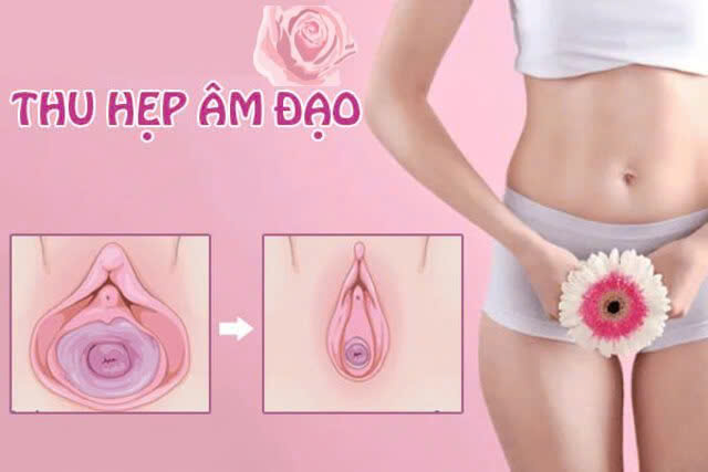 hình ảnh thu hẹp âm đạo