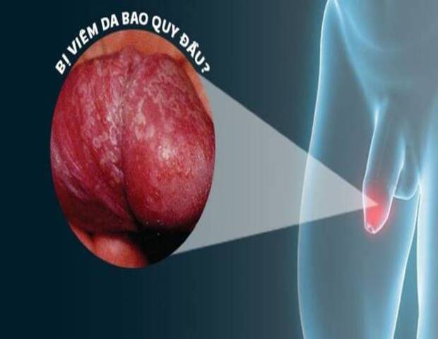 viêm bao quy đầu do nấm có thể gây nổi mụn dương vật viêm bao quy đầu do nấm có thể gây nổi mụn dương vật