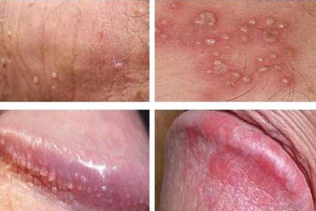 viêm rãnh bao quy đầu là bệnh viêm nhiễm dẫn đến tổn thương vùng bao quy đầu viêm rãnh bao quy đầu là bệnh viêm nhiễm dẫn đến tổn thương vùng bao quy đầu