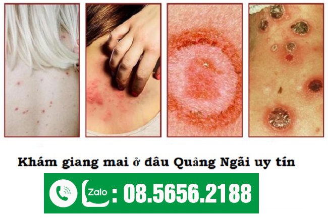 khám bệnh giang mai ở quảng ngãi