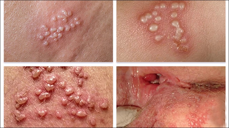 khám bệnh mụn rộp sinh dục ở đâu Bách Lạc